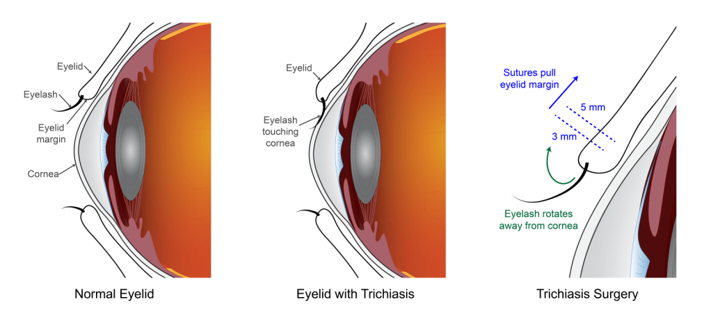 Surgical methods for treating trichiasis, a complication of the eye disease trachoma.